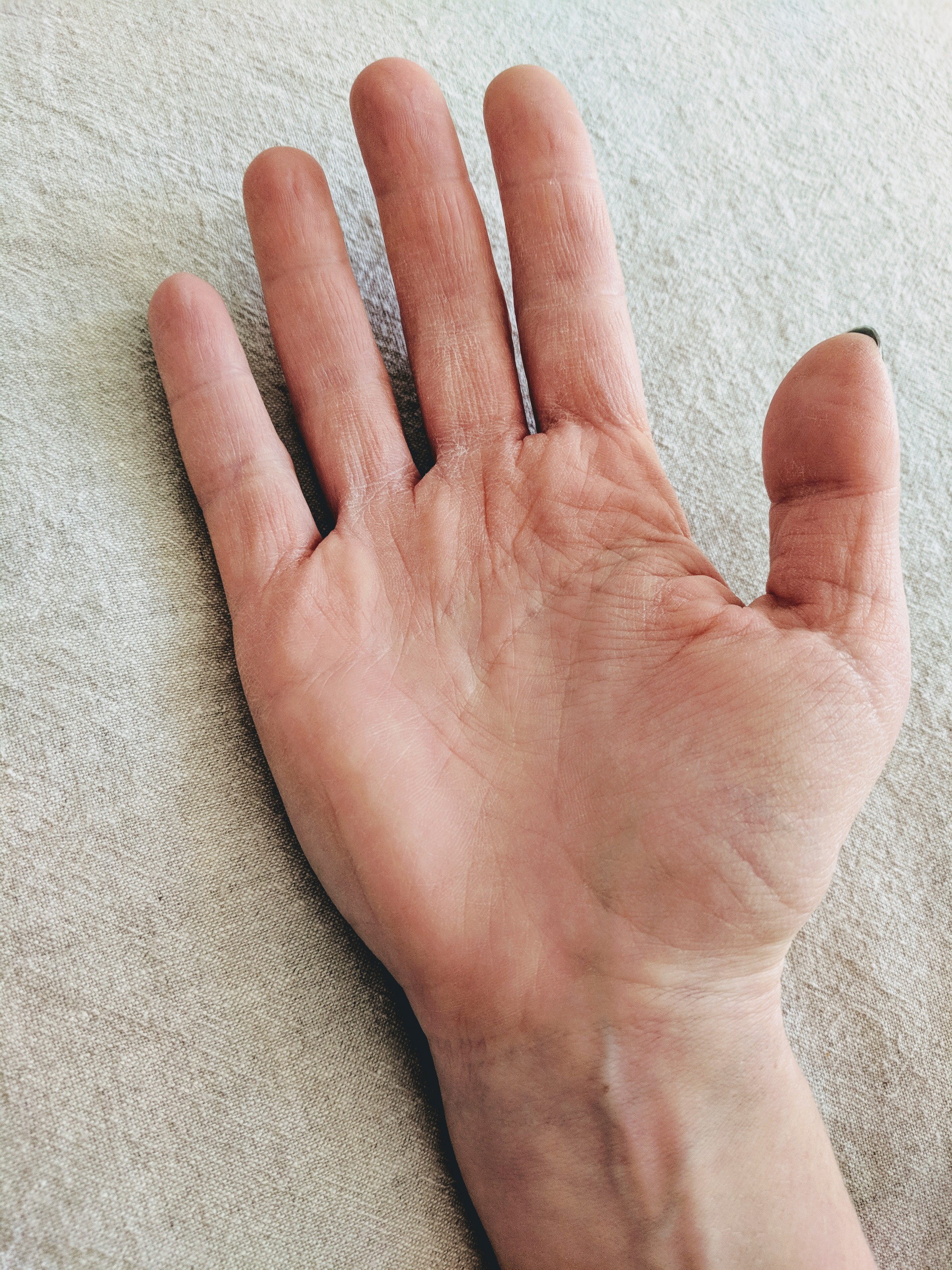 dry hands after ETS surgery