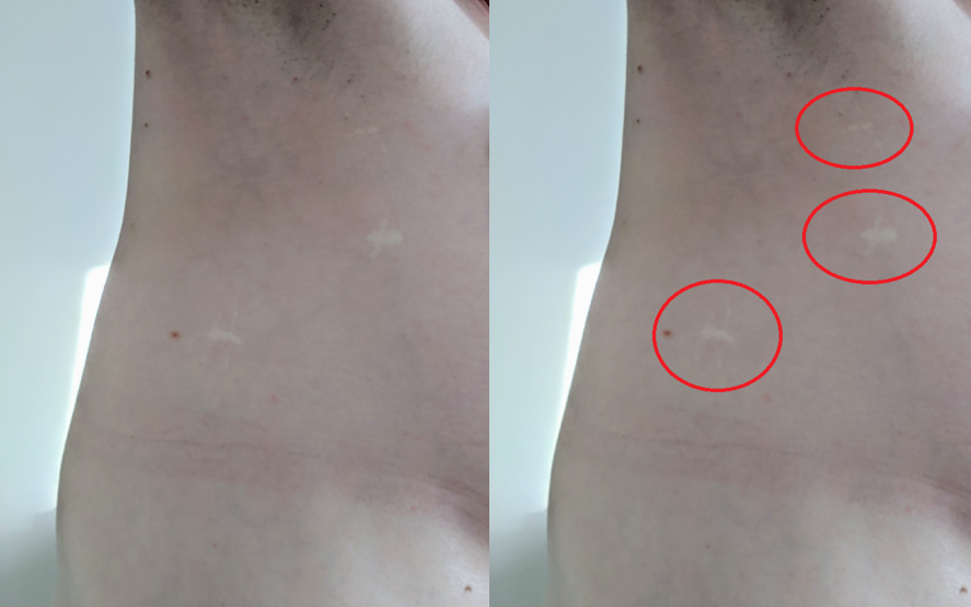 ETS surgery scars